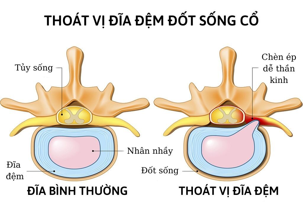 thoát vị đĩa đệm đốt sống cổ