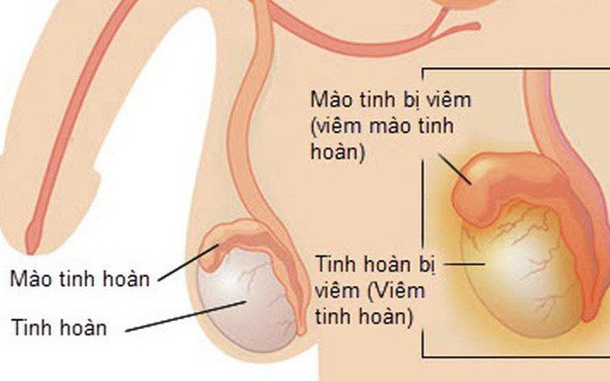 Viêm tinh hoàn - Nguyên nhân triệu chứng, cách phòng và điều trị