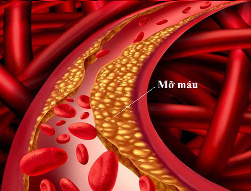Mách bạn cách làm giảm mỡ máu để bảo vệ sức khỏe tim mạch