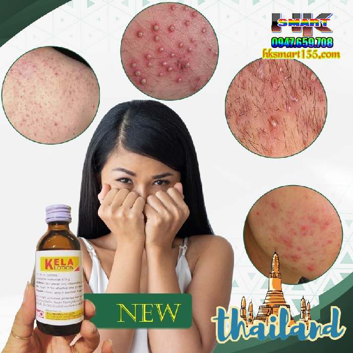 Dưỡng thể đặc trị viêm lỗ chân lông Kela Lotion
