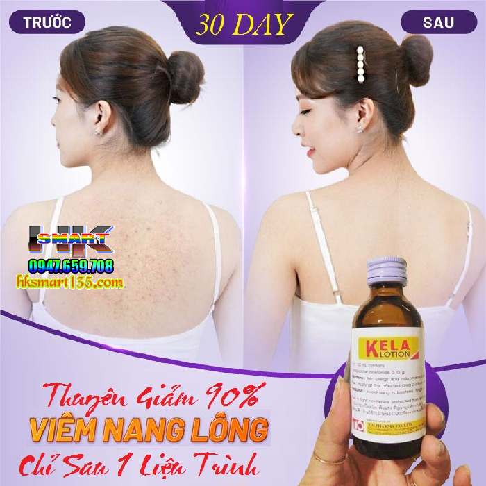 Dưỡng thể đặc trị viêm lỗ chân lông Kela Lotion