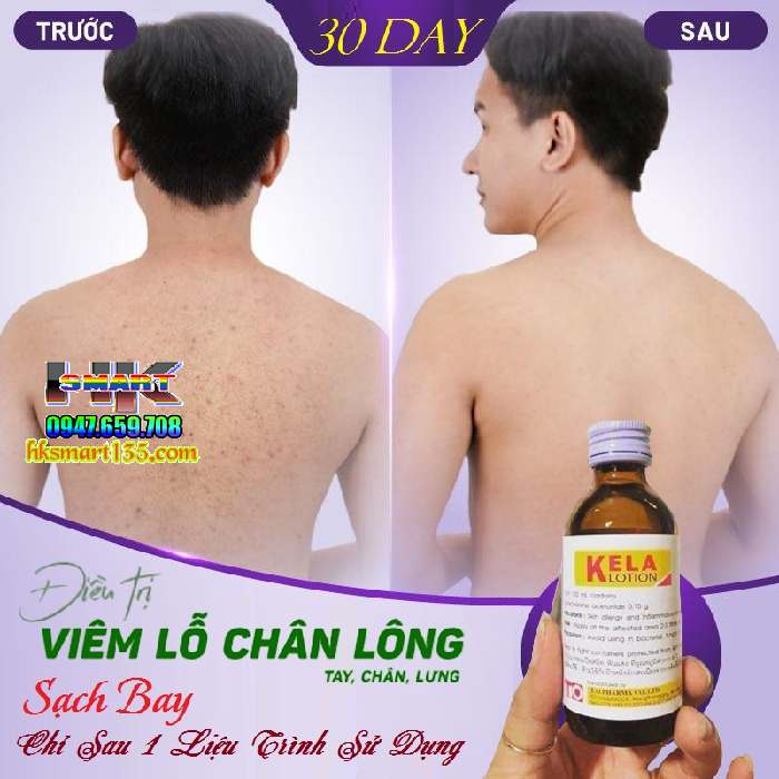 Dưỡng thể đặc trị viêm lỗ chân lông Kela Lotion