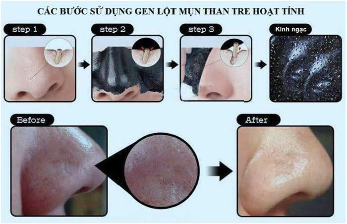 Gel hút mụn than hoạt tính 100% thiên nhiên
