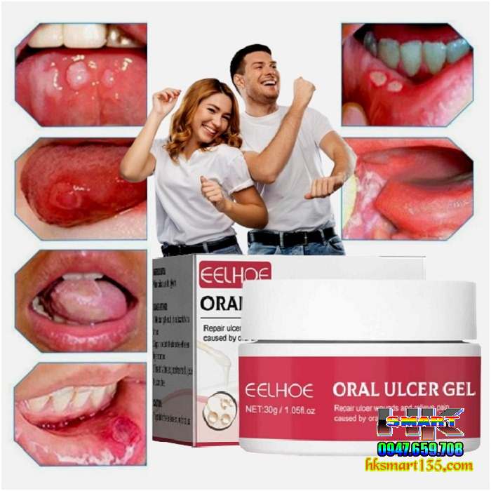 Gel Làm Dịu Giảm Đau Răng Miệng Mouth Oral Ulcer 30gr