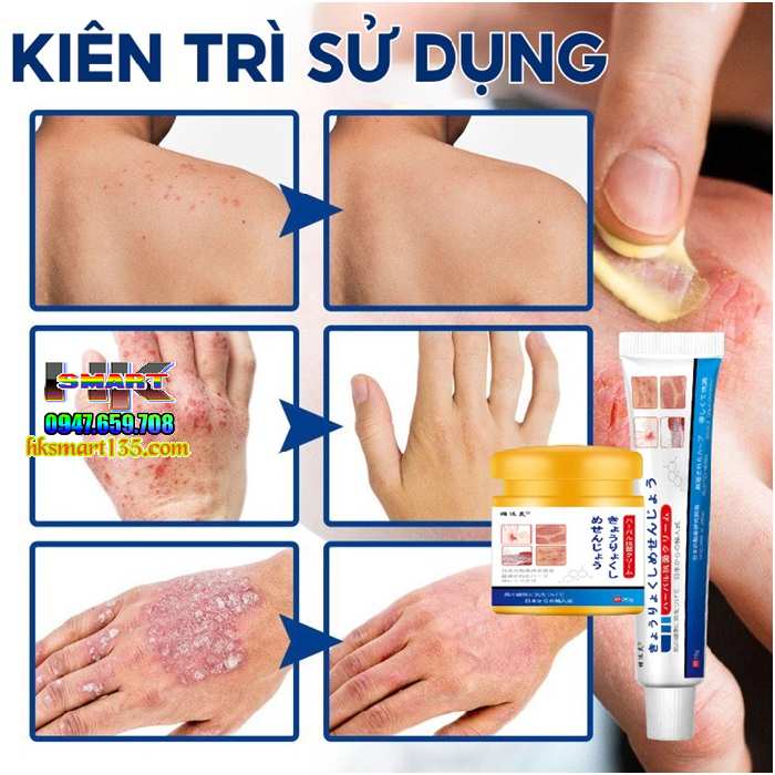 Combo Kem bôi đặc trị và ngừa tái phát nấm ngứa á sừng vảy nến Nhật Bản
