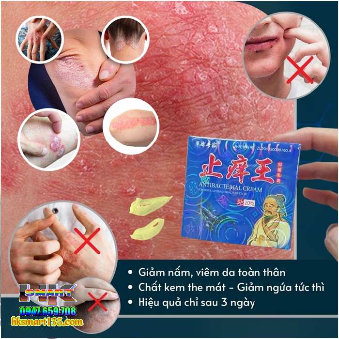 Hộp Xanh Kem Bôi Bọ Cạp Thần Y Đặc Trị Các Bệnh Ngoài Da
