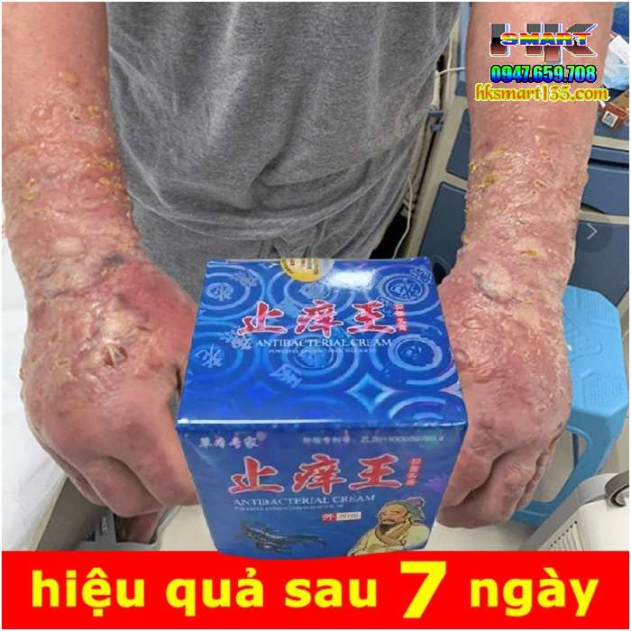 Hộp Xanh Kem Bôi Bọ Cạp Thần Y Đặc Trị Các Bệnh Ngoài Da