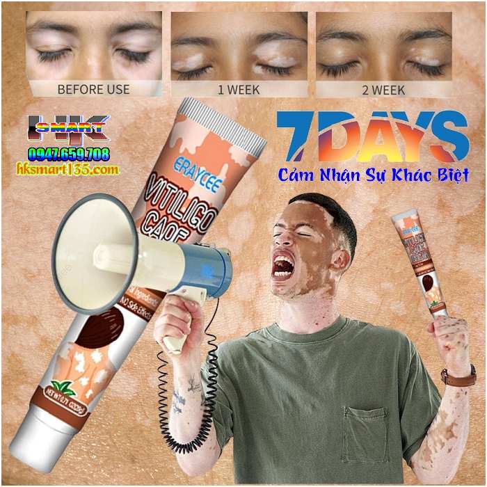 Kem bôi bạch biến lang ben Vitiligo ERAY CEE- 20gr làm mờ bạch biến đốm trắng