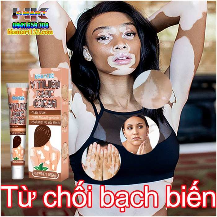 Kem bôi bạch biến lang ben Vitiligo ERAY CEE- 20gr làm mờ bạch biến đốm trắng