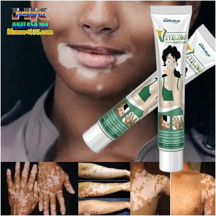 Kem Bôi Bạch Biến Lang Ben Vitiligo South Moon-20gr- Trị Mờ Bạch Biến Đốm Trắng Nám Thâm Hiệu Quả