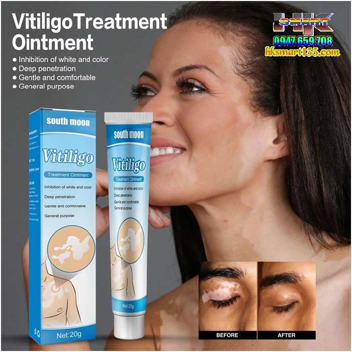 Kem Bôi Bạch Biến Lang Ben Vitiligo South Moon-20gr- Trị Mờ Bạch Biến Đốm Trắng Nám Thâm Hiệu Quả