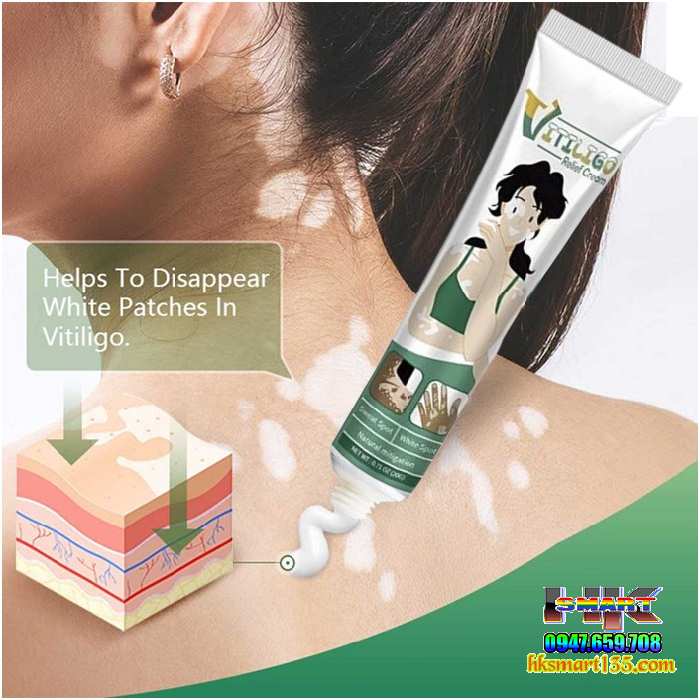 Kem Bôi Bạch Biến Lang Ben Vitiligo South Moon-20gr- Trị Mờ Bạch Biến Đốm Trắng Nám Thâm Hiệu Quả