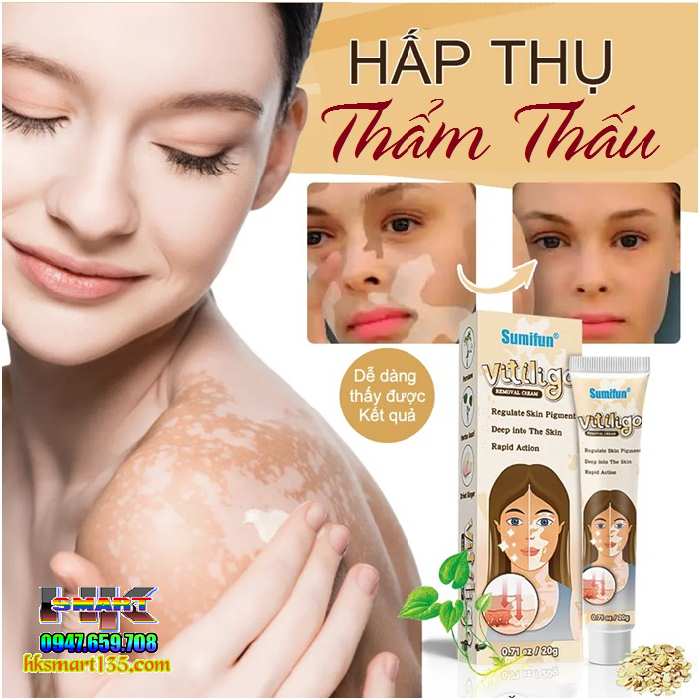 Kem bôi bạch biến lang ben Vitiligo - 20gr làm mờ bạch biến đốm trắng