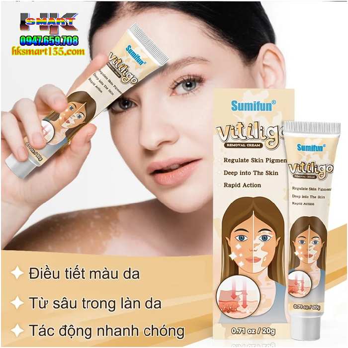 Kem bôi bạch biến lang ben Vitiligo - 20gr làm mờ bạch biến đốm trắngV