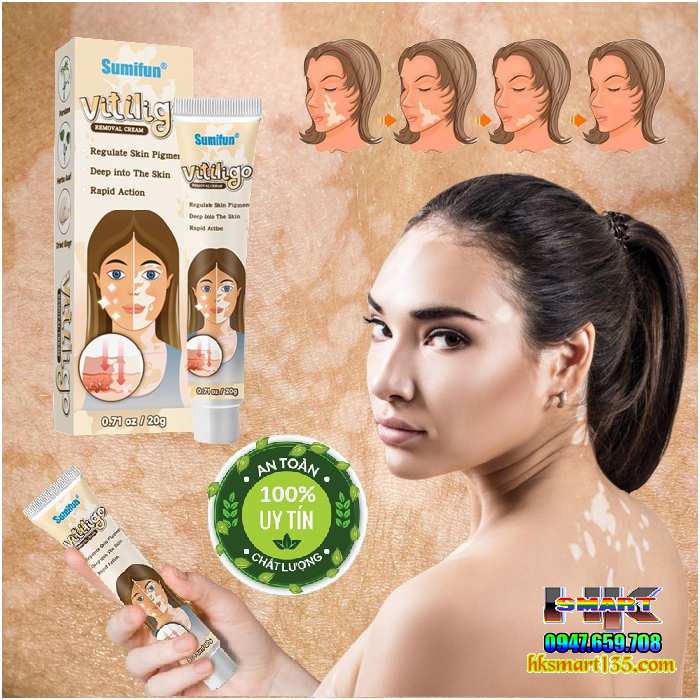 Kem bôi bạch biến lang ben Vitiligo - 20gr làm mờ bạch biến đốm trắng