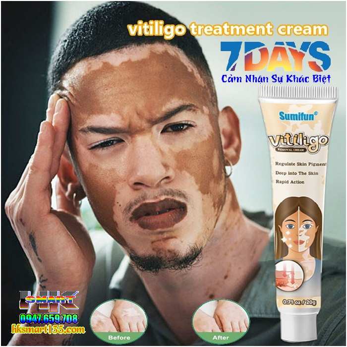 Kem bôi bạch biến lang ben Vitiligo - 20gr làm mờ bạch biến đốm trắng