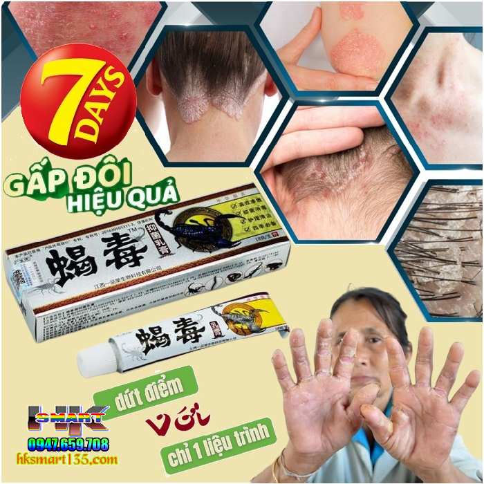 Kem Bôi Da Liễu Bọ Cạp Phiên Bản 2025 Đặc Trị Nấm Ngứa, Ghẻ Lở, Hắc Lào, Á Sừng, Mề Đay, Tổ Đỉa, Vảy Nến, Viêm Da Cơ Địa