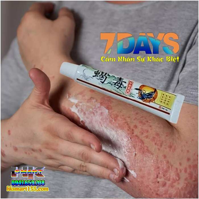 Kem Bôi Da Liễu Bọ Cạp Phiên Bản 2025 Đặc Trị Nấm Ngứa, Ghẻ Lở, Hắc Lào, Á Sừng, Mề Đay, Tổ Đỉa, Vảy Nến, Viêm Da Cơ Địa