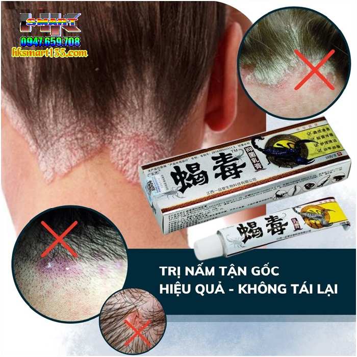Kem Bôi Da Liễu Bọ Cạp Phiên Bản 2025 Đặc Trị Nấm Ngứa, Ghẻ Lở, Hắc Lào, Á Sừng, Mề Đay, Tổ Đỉa, Vảy Nến, Viêm Da Cơ Địa