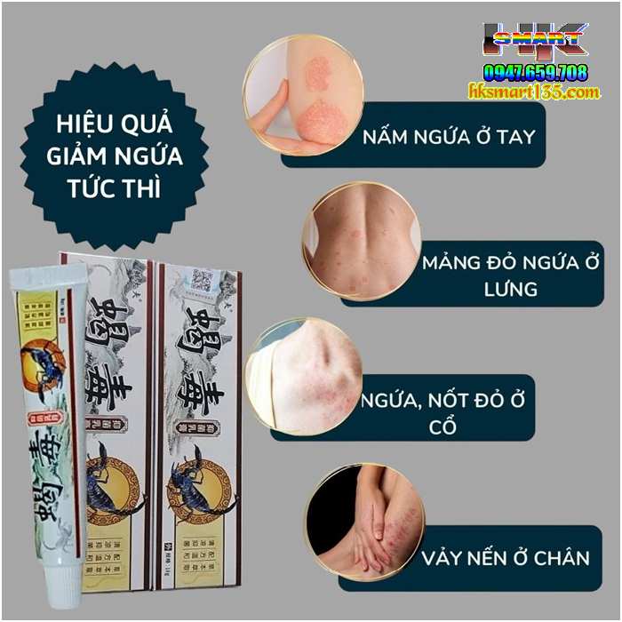 Kem Bôi Da Liễu Bọ Cạp Phiên Bản 2025 Đặc Trị Nấm Ngứa, Ghẻ Lở, Hắc Lào, Á Sừng, Mề Đay, Tổ Đỉa, Vảy Nến, Viêm Da Cơ Địa