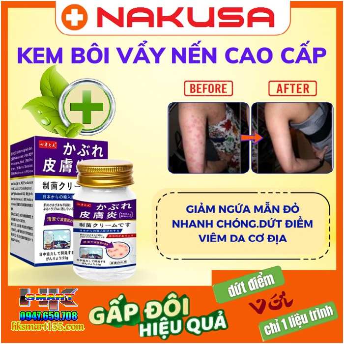 Kem bôi Nakusa đặc trị viêm da cơ địa, á sừng, vảy nến đến từ Nhật Bản