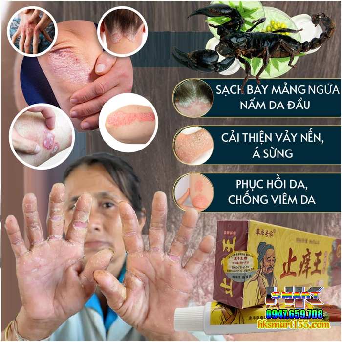 Kem Bôi Bọ Cạp Đặc Trị Viêm Da Cơ địa, Á Sừng, Vảy Nến Thần Y Hoa Đà,