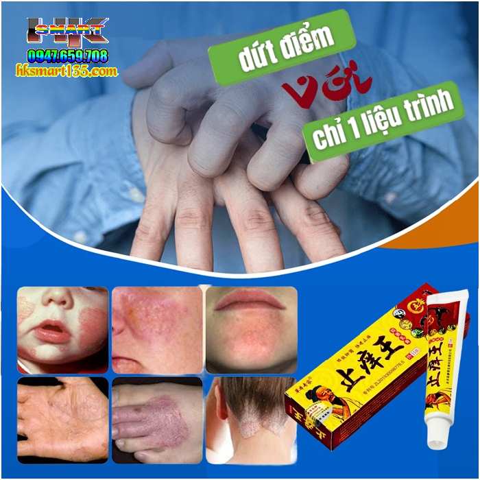 Kem Bôi Bọ Cạp Đặc Trị Viêm Da Cơ địa, Á Sừng, Vảy Nến Thần Y Hoa Đà,