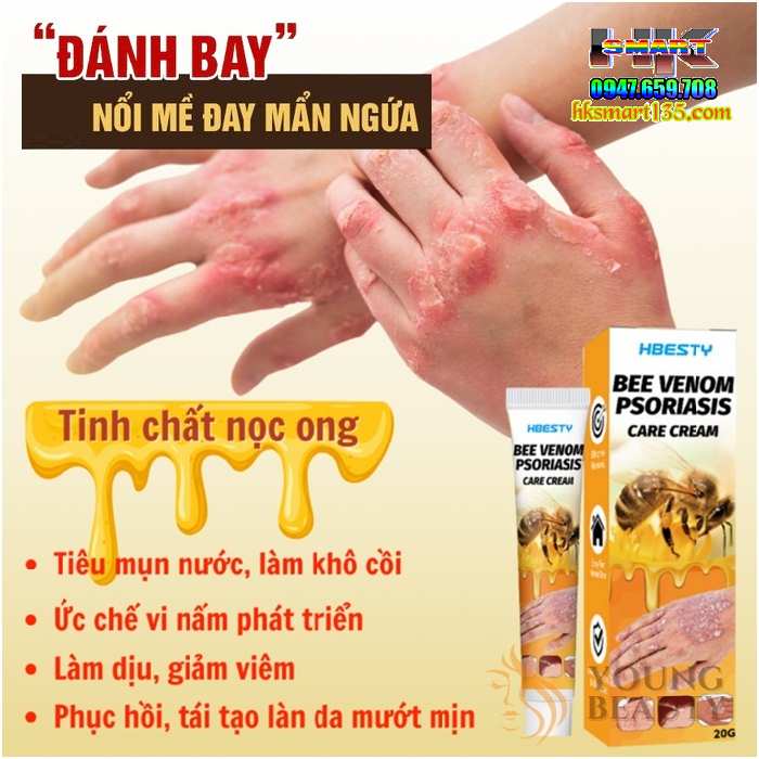 Kem Bôi Nọc Ong Đặc Trị Nấm Ngứa, mụn Nước Hbesty 20gr- Cho Da Viêm, Chàm Eczema, tổ Đỉa, Vẩy Nến Á Sừng