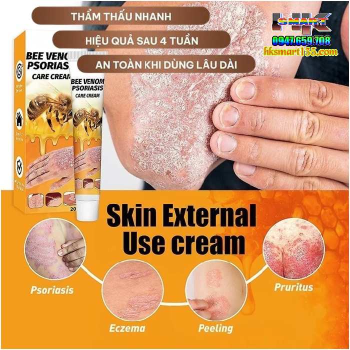 Kem Bôi Nọc Ong Đặc Trị Nấm Ngứa, mụn Nước Hbesty 20gr- Cho Da Viêm, Chàm Eczema, tổ Đỉa, Vẩy Nến Á Sừng