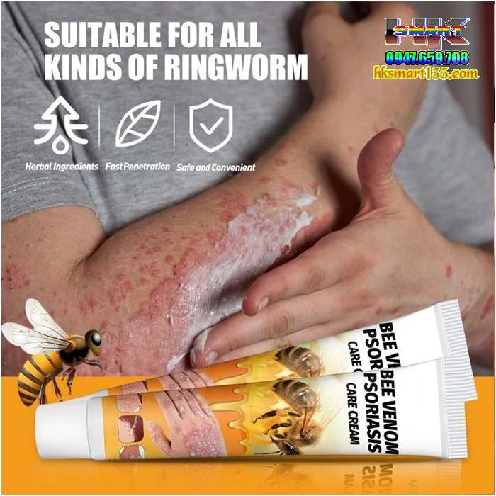 Kem Bôi Nọc Ong Đặc Trị Nấm Ngứa, mụn Nước Hbesty 20gr- Cho Da Viêm, Chàm Eczema, tổ Đỉa, Vẩy Nến Á Sừng