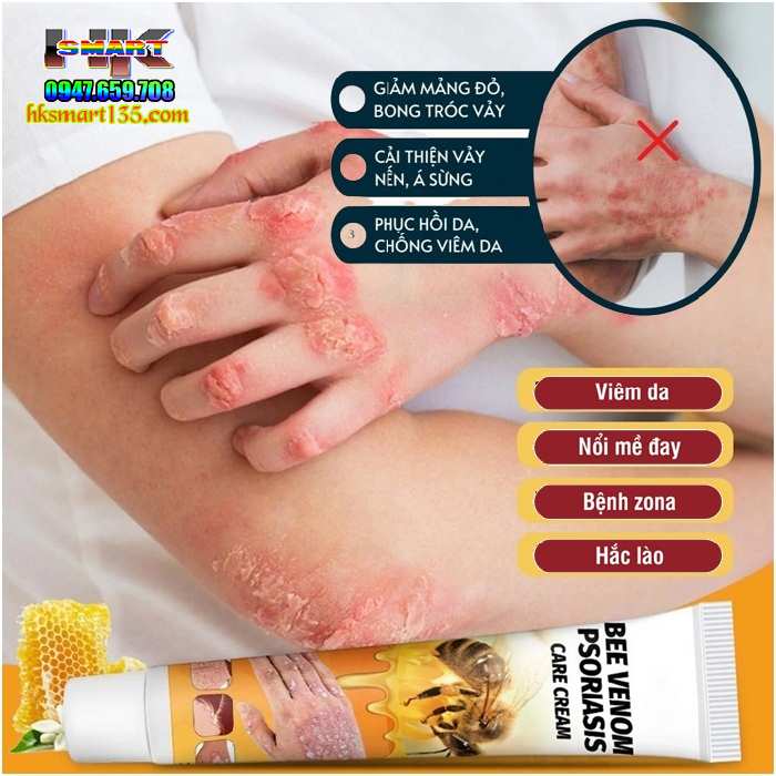 Kem Bôi Nọc Ong Đặc Trị Nấm Ngứa, mụn Nước Hbesty 20gr- Cho Da Viêm, Chàm Eczema, tổ Đỉa, Vẩy Nến Á Sừng