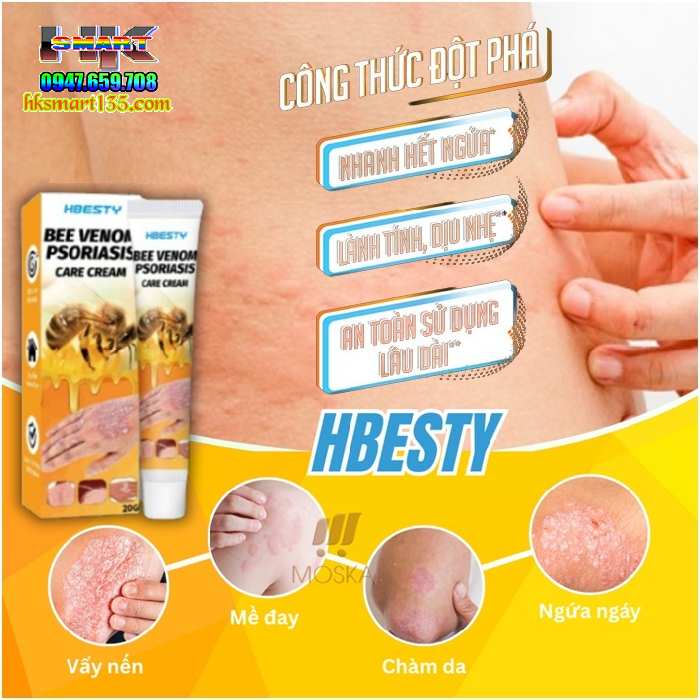 Kem Bôi Nọc Ong Đặc Trị Nấm Ngứa, mụn Nước Hbesty 20gr- Cho Da Viêm, Chàm Eczema, tổ Đỉa, Vẩy Nến Á Sừng