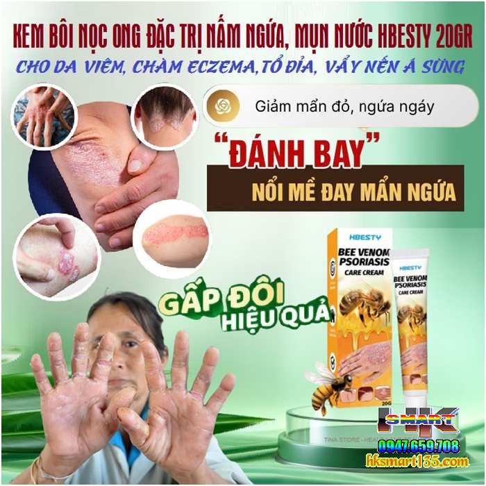 Kem Bôi Nọc Ong Đặc Trị Nấm Ngứa, mụn Nước Hbesty 20gr- Cho Da Viêm, Chàm Eczema, tổ Đỉa, Vẩy Nến Á Sừng