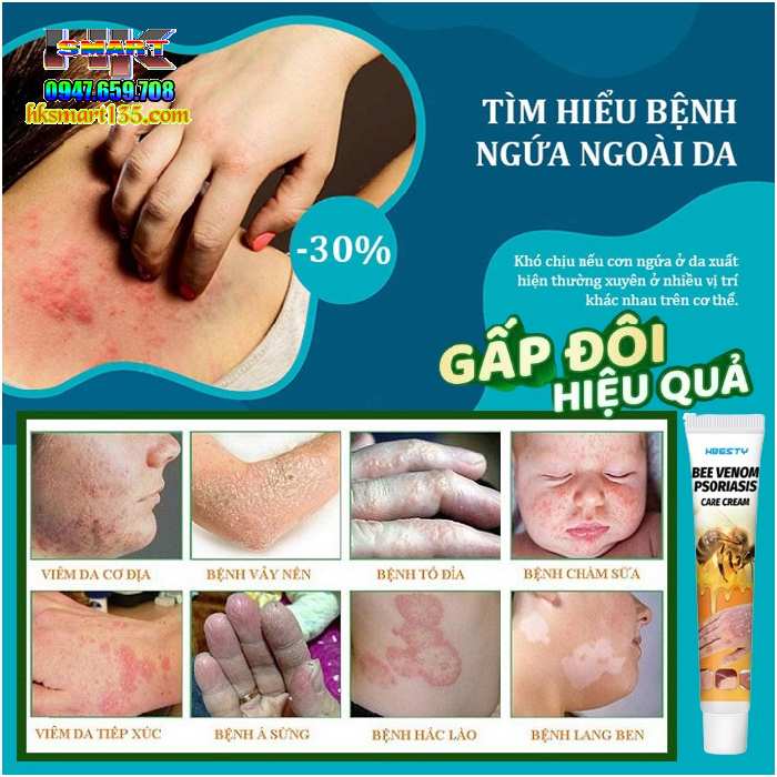 Kem Bôi Nọc Ong Đặc Trị Nấm Ngứa, mụn Nước Hbesty 20gr- Cho Da Viêm, Chàm Eczema, tổ Đỉa, Vẩy Nến Á Sừng