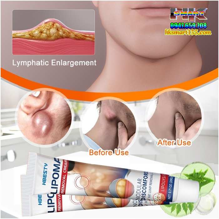 Kem Loại Bỏ Đánh Tan U Mỡ Bướu Cổ Hbesty Lipoma Nodular 20gr- Thảo Dược Thiên Nhiên