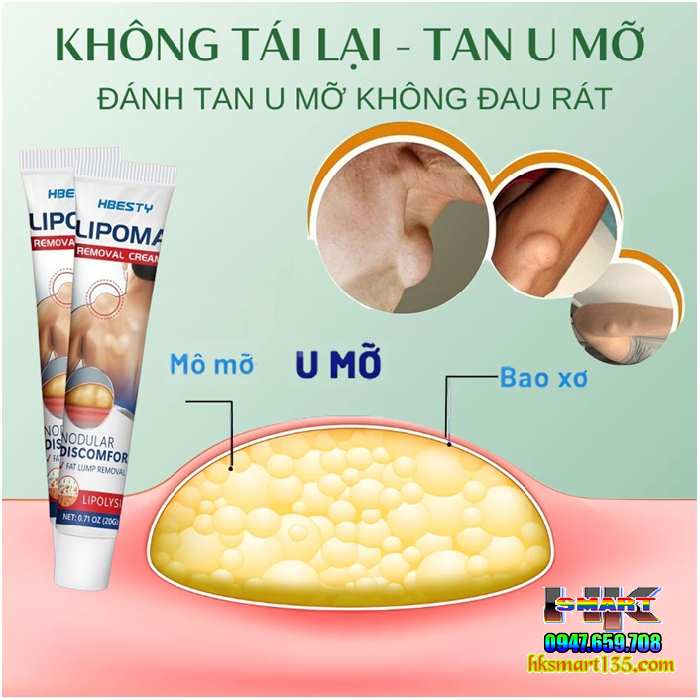 Kem Loại Bỏ Đánh Tan U Mỡ Bướu Cổ Hbesty Lipoma Nodular 20gr- Thảo Dược Thiên Nhiên