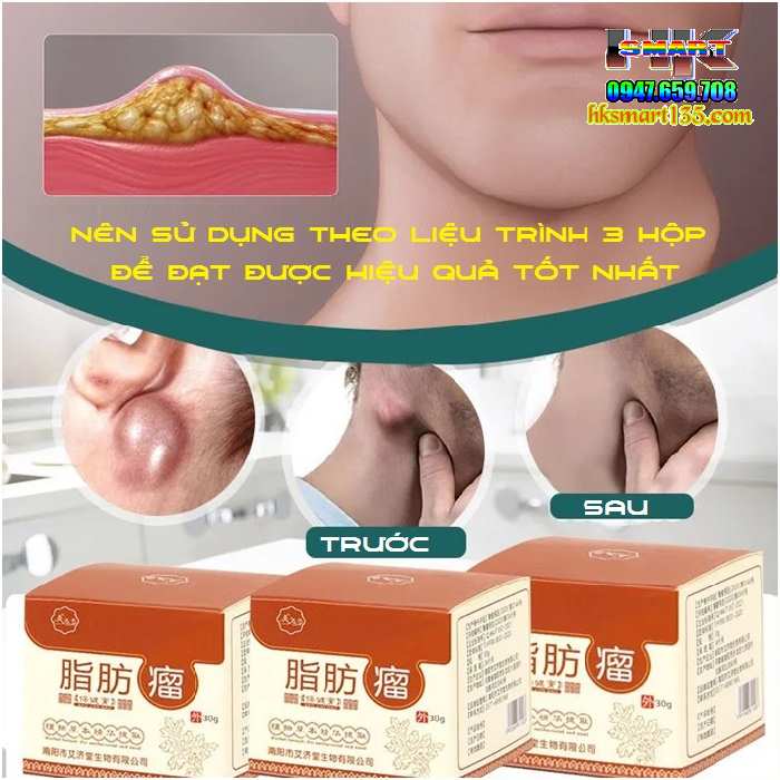 Hũ Kem Thảo Mộc Loại Bỏ Đánh Tan U Mỡ Bướu Cổ Nanyang Lipoma 30gr