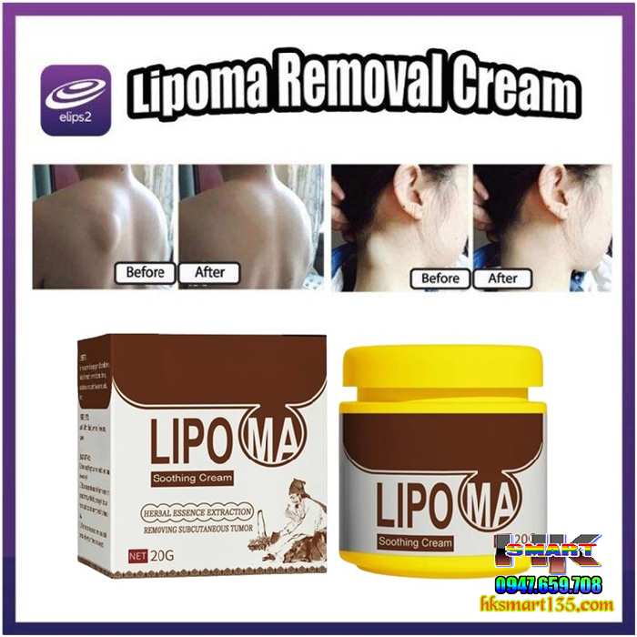Hũ Kem Thảo Mộc Loại Bỏ Đánh Tan U Mỡ Bướu Cổ Shoothing Lipoma 20gr