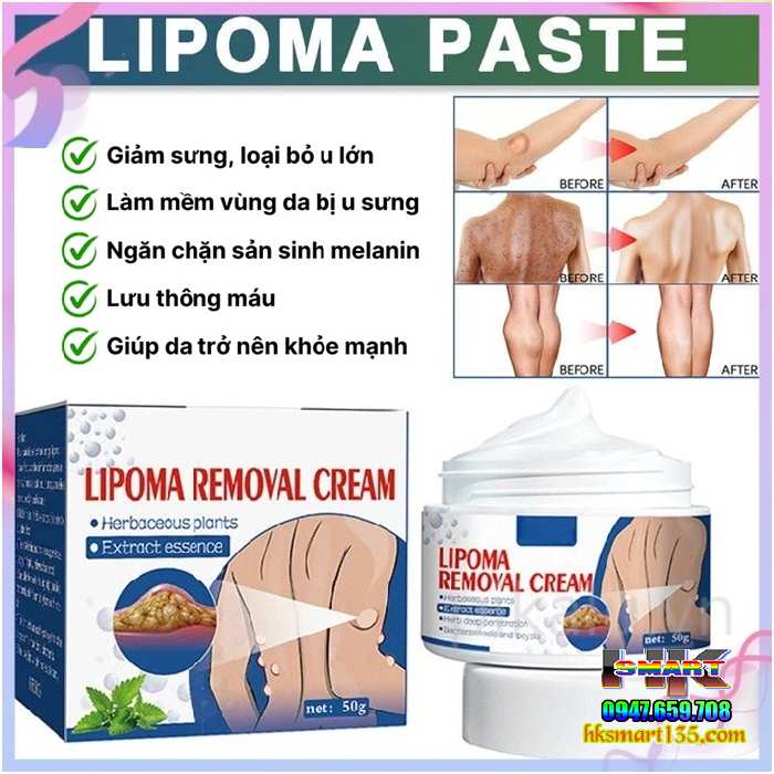 Hũ Kem Thảo Mộc Loại Bỏ Đánh Tan U Mỡ Bướu Cổ ShootMoon Lipoma 50gr