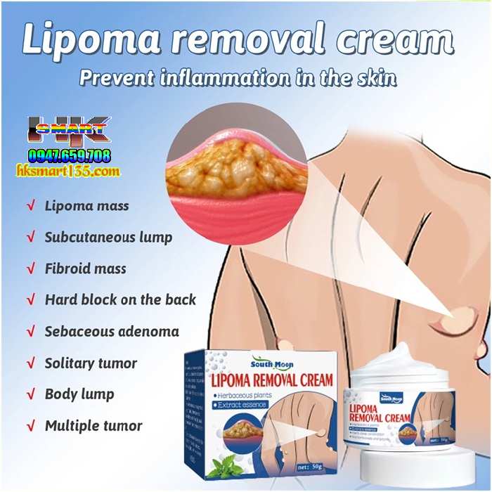 Hũ Kem Thảo Mộc Loại Bỏ Đánh Tan U Mỡ Bướu Cổ ShootMoon Lipoma 50gr
