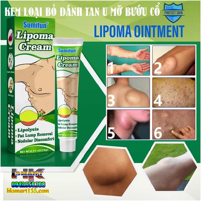 Kem Loại Bỏ Đánh Tan U Mỡ Bướu Cổ Tuyến Giáp Dưới Da Sumifun Lipoma Lipolysis 20gr