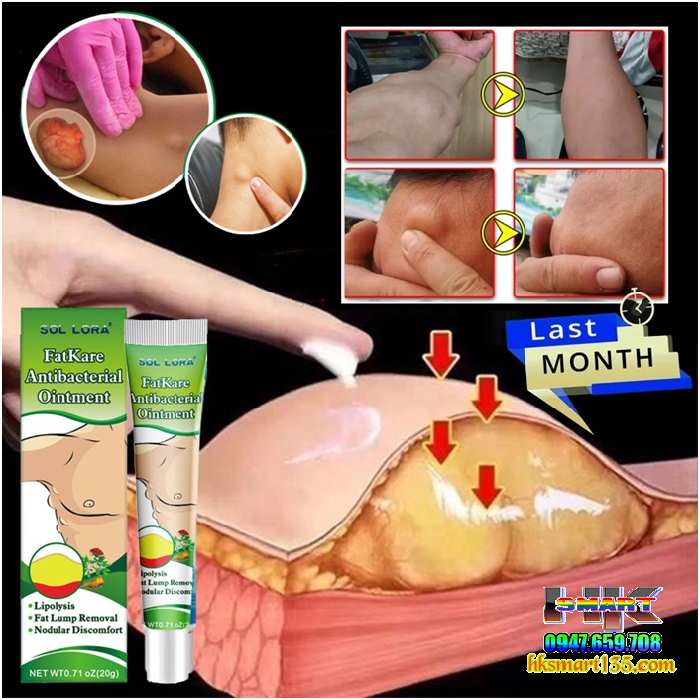 Kem Loại Bỏ Đánh Tan U Mỡ Bướu Cổ Tuyến Giáp Dưới Da Sumifun Lipoma Lipolysis 20gr