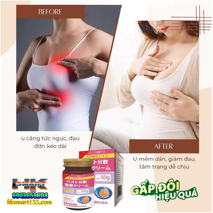 Kem Tan U Bướu Tuyến Vú, Tiêu Nang Senjoko Nhật Bản 50gr- Hỗ Trợ Hiệu Quả U Mỡ, Bướu Hạch, U Xơ Tuyến Vú