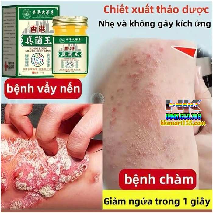 Nấm Vương Hồng Kông Hũ Vàng 50gr-Chuyên Trị Nấm Ngứa, Hắc Lào Tổ Đỉa, Ghẻ, Á Sừng, Dị Ứng, Mề Đay, Viêm Da Cơ Địa
