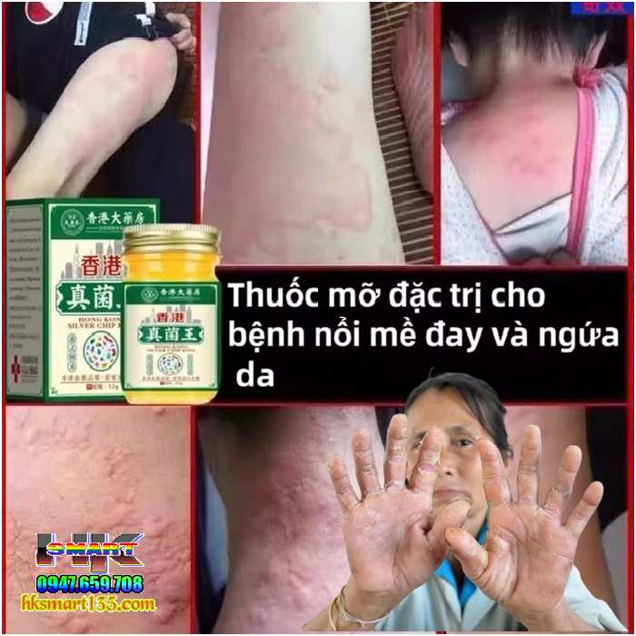 Nấm Vương Hồng Kông Hũ Vàng 50gr-Chuyên Trị Nấm Ngứa, Hắc Lào Tổ Đỉa, Ghẻ, Á Sừng, Dị Ứng, Mề Đay, Viêm Da Cơ Địa