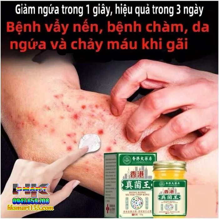 Nấm Vương Hồng Kông Hũ Vàng 50gr-Chuyên Trị Nấm Ngứa, Hắc Lào Tổ Đỉa, Ghẻ, Á Sừng, Dị Ứng, Mề Đay, Viêm Da Cơ Địa