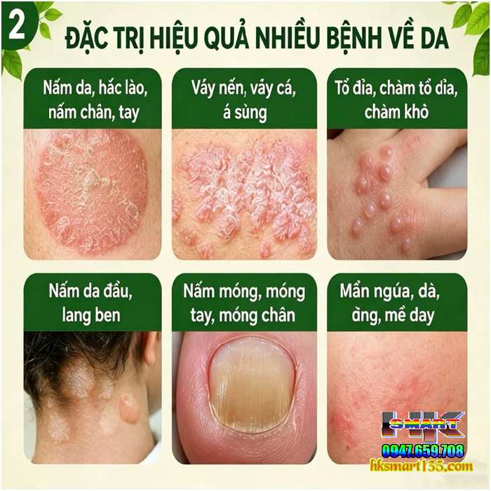 Nấm Vương Hồng Kông Hũ Vàng 50gr-Chuyên Trị Nấm Ngứa, Hắc Lào Tổ Đỉa, Ghẻ, Á Sừng, Dị Ứng, Mề Đay, Viêm Da Cơ Địa