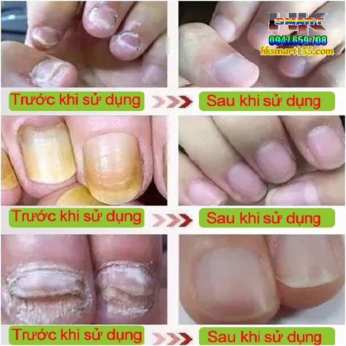 Kem Bọ Cạp Đen Thảo Mộc Trị Nấm Da Móng Tay Chân 15gr