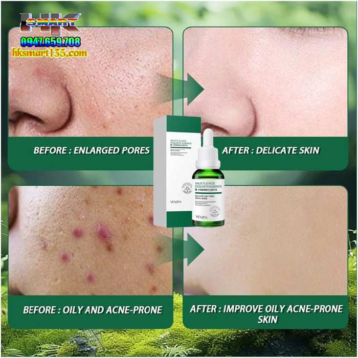 Serum Axit Salicylic 30ml/ 60gr- Tinh Chất Se Khít Thu Nhỏ Lỗ Chân Lông, Lột Mụn Đầu Đen, Dưỡng Trắng Chống Lão Hóa Trẻ Hóa Làn Da