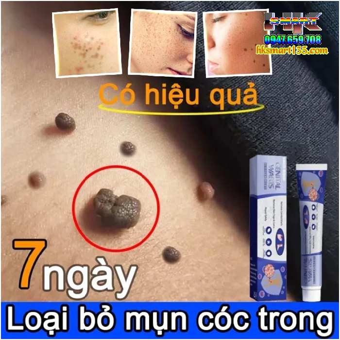 Kem Loại Bỏ Mụn Ruồi South Moon Wart Remoal Cream